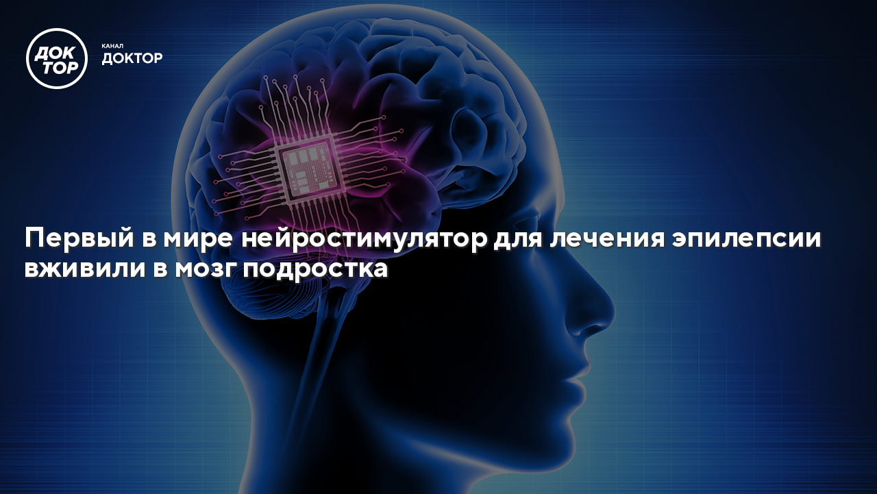 Первый в мире нейростимулятор для лечения эпилепсии вживили в мозг ...