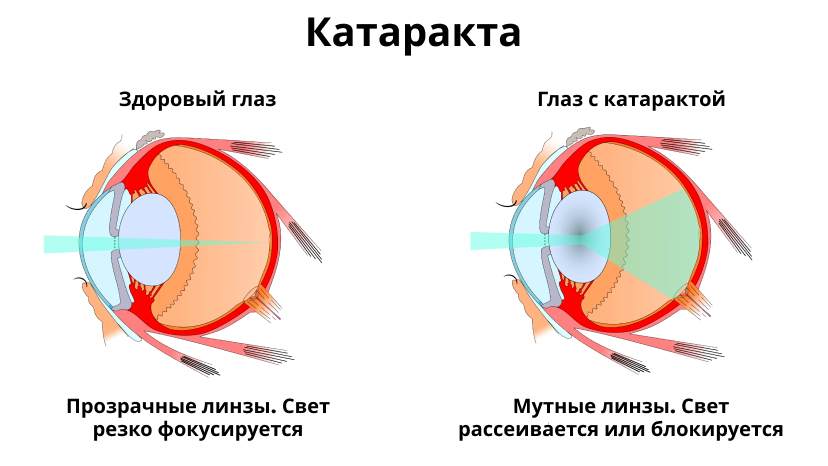 катаракта, симптомы