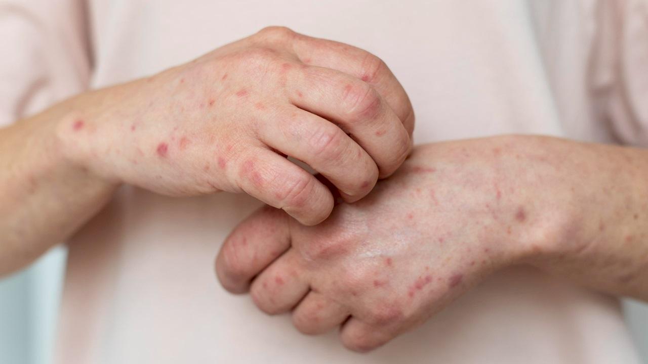 Оспа обезьян проникает в Россию: подтвержден случай заражения, еще один — под вопросом