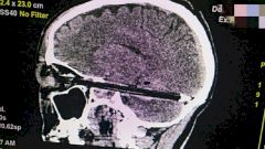 Врачи Ростова-на-Дону спасли мужчину с застрявшей шариковой ручкой в голове