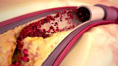 Нарушения сна оказались причиной проблем с сосудами