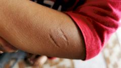 В Петербурге мужчина умер после инфекции, вызванной укусом прохожего