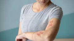 Назван вид герпеса, на 20% повышающий риск деменции в будущем