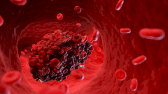 Российские медики спасли бабушку с подвижным тромбом