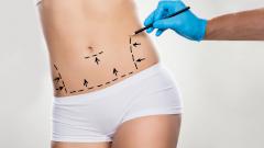 Абдоминопластика — операция по подтяжке мышц живота