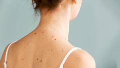 Влияет не только солнце: выяснилось, сколько людей подвержены генетическому риску меланомы