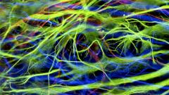 Находки Доктора: первому пациенту, страдающему от Паркинсона, вживили нейроны черной субстанции