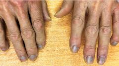 Странный случай: серые ногти, кожа и белки глаз жителя Гонконга удивили врачей