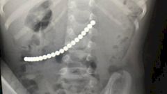 В Подмосковье спасли малыша, проглотившего 20 магнитных шариков