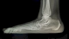 Что делать, если у вас плоскостопие?