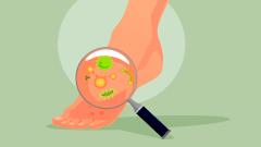 10 фактов про лишай