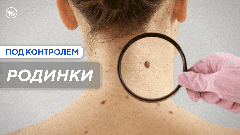 Какие родинки наиболее опасны