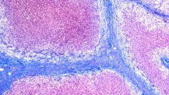 Как вылечить цирроз печени?