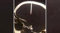 Находки Доктора: гвоздь в голове, памятник Склифосовскому и вред от сна на животе