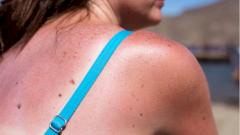 Исследование показало, как возникает рак кожи после солнечных ожогов