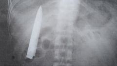 Филиппинец прожил 15 месяцев с ножом в груди