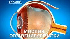 Миопия и отслоение сетчатки: кому поможет операция?