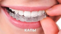 Капы для исправления прикуса: можно ли обойтись без брекетов?