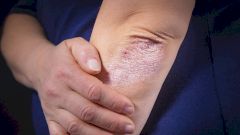 Псориаз: симптомы, причины, лечение