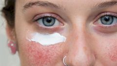 Синдром красного лица. Как бороться с розацеа?
