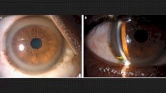 Медные кольца на радужках помогли выявить у пациента редкое заболевание