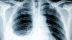 Боль в груди: плеврит и его симптомы