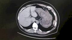 Женщина восемь лет прожила с рыбьей костью в печени