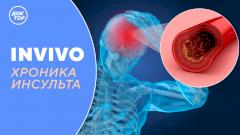 Хроника инсульта | IN VIVO