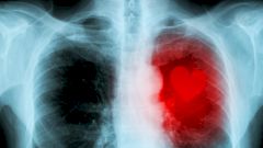 Пробка в сердце: дорога заблокирована