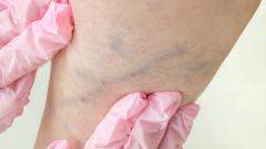 Как победить варикоз?