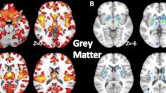 Выявлен новый «незаметный» тип шизофрении