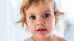 Почему стоит привиться от ветрянки?