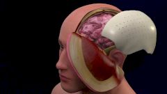 Все, что нужно знать о краниопластике