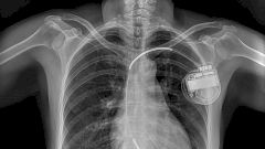 Изобретение, которое спасает от аритмии: история создания ИКД