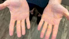 Мужчина стал истекать холестерином из-за избытка животной пищи