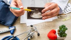 Описан редкий случай «блуждающей селезенки»