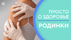 Родинки на теле и рак кожи