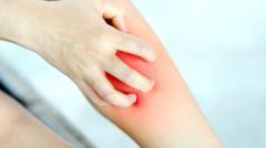 Подмосковные врачи спасли женщину от потери ноги после укуса мошки