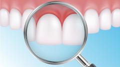 Болезни десен делают COVID-19 более опасным