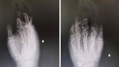 травма, рука, кисть, врачи