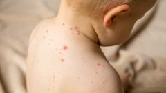 Как защититься от кори?