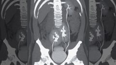У бразильца, жаловавшегося на боли в спине, обнаружили дополнительный орган