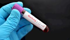 Может ли вирус Марбург дойти до России: отвечают инфекционисты