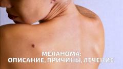 Меланома