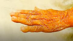 Можно ли предотвратить болезнь Паркинсона?