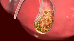 Все тайны желчного камня