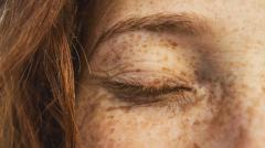 Эксперты рассказали, как отличить веснушки от родинок и пигментных пятен