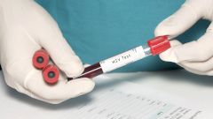 В России снизилась заболеваемость ВИЧ