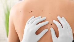 Назван самый распространённый вид онкозаболеваний в России