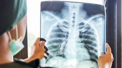 Поражение легких у больных COVID-19 стало развиваться в два раза быстрее